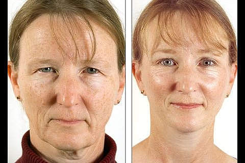 Facial Plastic Surgery: Avant et Après pour mac